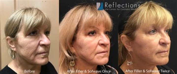Did She Get Botox and Fillers on Her Face? ·