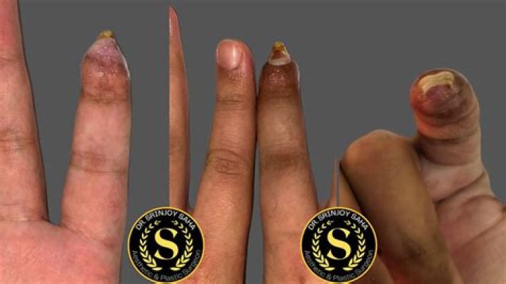 The One With Matthew Perry's Missing Fingertip: How 'Friends' worked into actor's freak accident